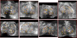 reconstruction-srie-8patients